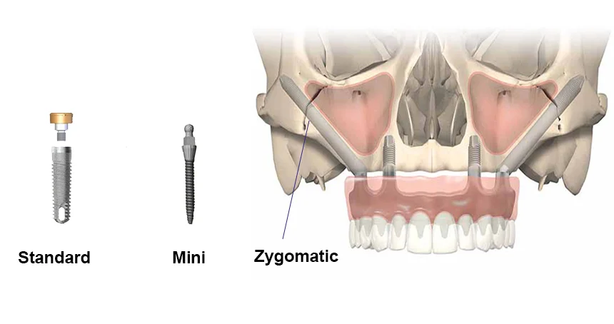 Different Dental Implant Types